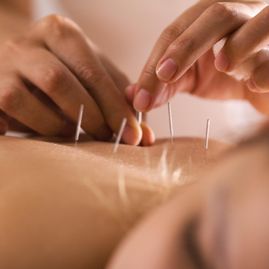 Acupuncture